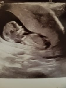 a ultrasound of a baby